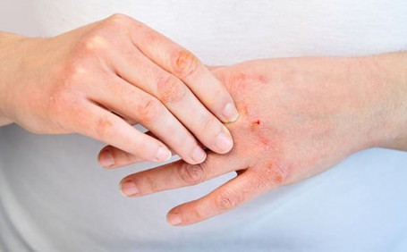 乳膠手套能否有效防止長(zhǎng)水泡？